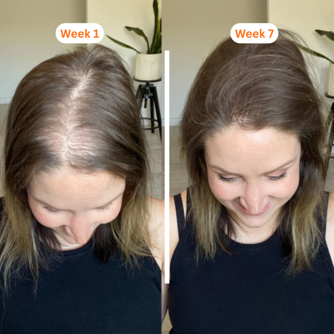 Korea's #1 Hair Growth Secret: Somarve Growth Ampoule